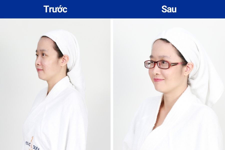 Vết thâm đỏ sau mụn: Nguyên nhân và 10 cách trị nhanh nhất 35 cách trị mụn thâm đỏ nhanh nhất