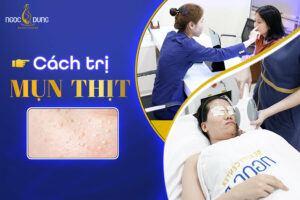 11 Cách trị mụn thịt tận gốc tại nhà bằng liệu pháp thiên nhiên