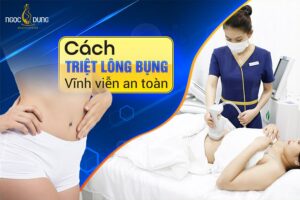 Triệt lông bụng vĩnh viễn
