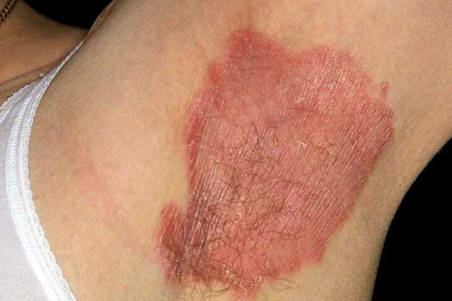 Dọn lông nách sai cách có thể tiềm ẩn nhiều rủi ro