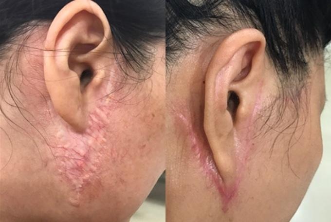 Căng da mặt có thể đem đến nhiều hệ lụy khi chọn sai cơ sở làm đẹp