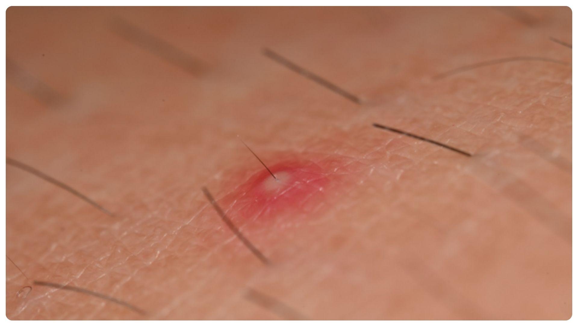 Viêm nang lông là gì? Nguyên nhân, dấu hiệu và phòng ngừa 3 Cấu trúc da bị tổn thương dẫn đến tình trạng viêm nang lông