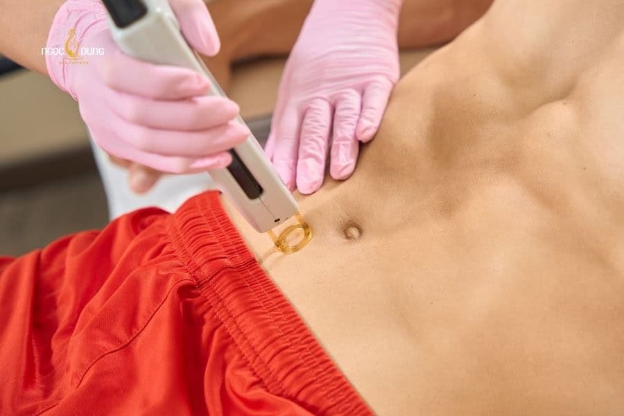 Quyết định triệt lông bụng phụ thuộc vào nhu cầu thẩm mỹ và sự thoải mái cá nhân