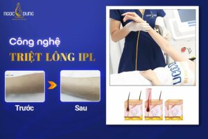 Công nghệ triệt lông IPL