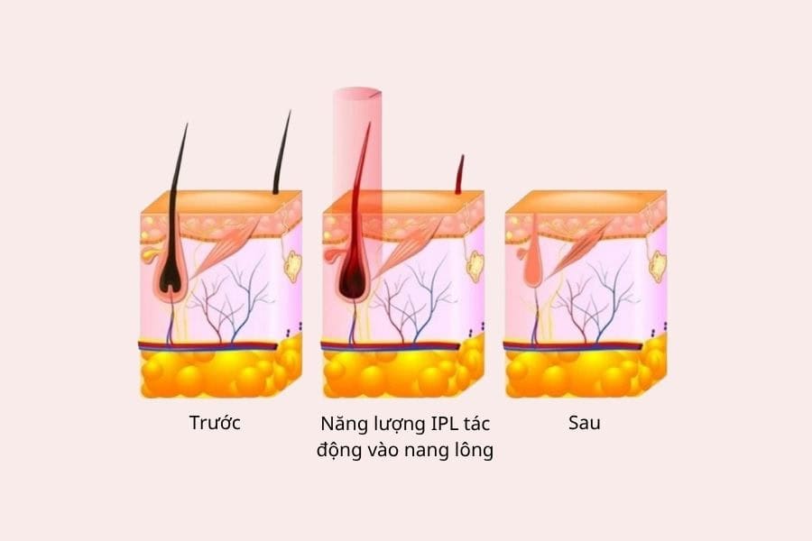 IPL hoạt động theo cơ chế làm lông mọc chậm, thưa và mảnh hơn sau nhiều lần điều trị