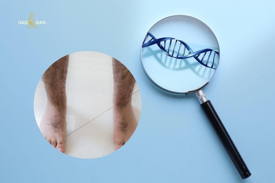 Yếu tố di truyền là nguyên nhân phổ biến nhất khiến lông chân phát triển mạnh ở cả nam và nữ