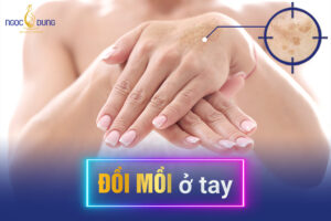 Bị đồi mồi ở tay là do đâu?