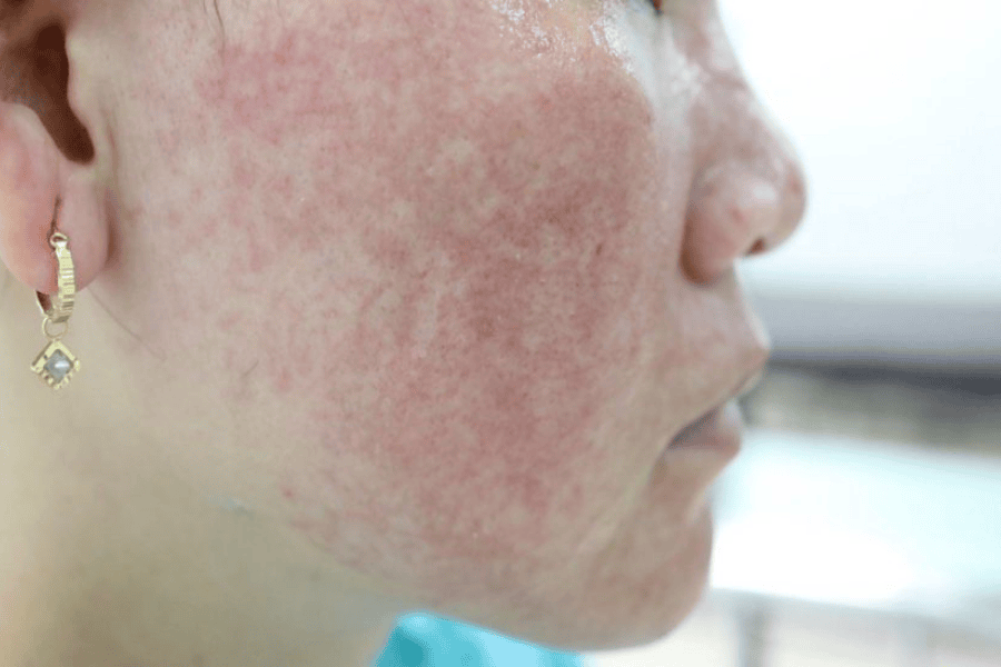 Cách ngăn ngừa nám da hiệu quả giúp duy trì làn da sáng khỏe 10 Tác hại nghiêm trọng sau khi sử dụng mỹ phẩm kém chất lượng