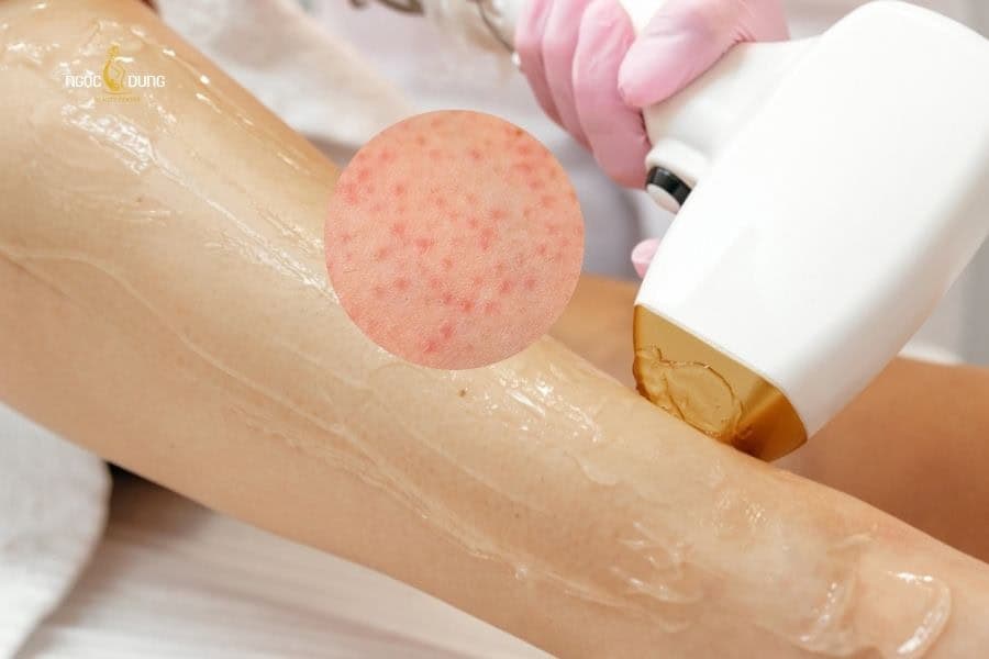 Dùng thuốc kém chất lượng cũng là nguyên nhân giải đáp vì sao triệt lông xong lại bị ngứa