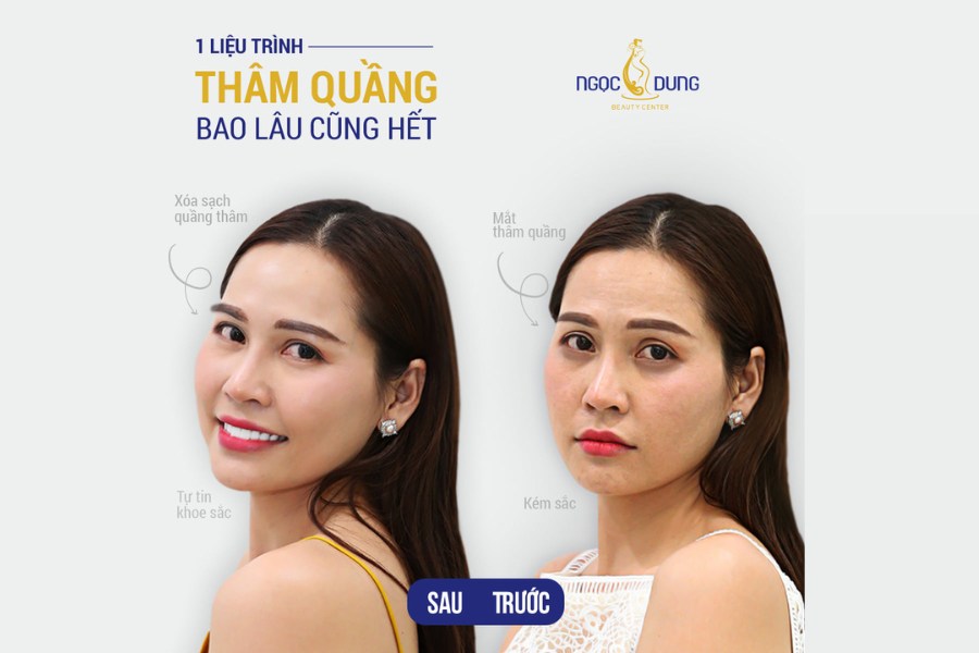 Hết thâm mắt chỉ sau 1 liệu trình tại Thẩm mỹ viện Ngọc Dung