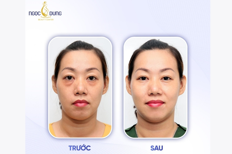Kết quả điều trị thâm mắt tại TMV Ngọc Dung Kết quả điều trị thâm mắt tại TMV Ngọc Dung