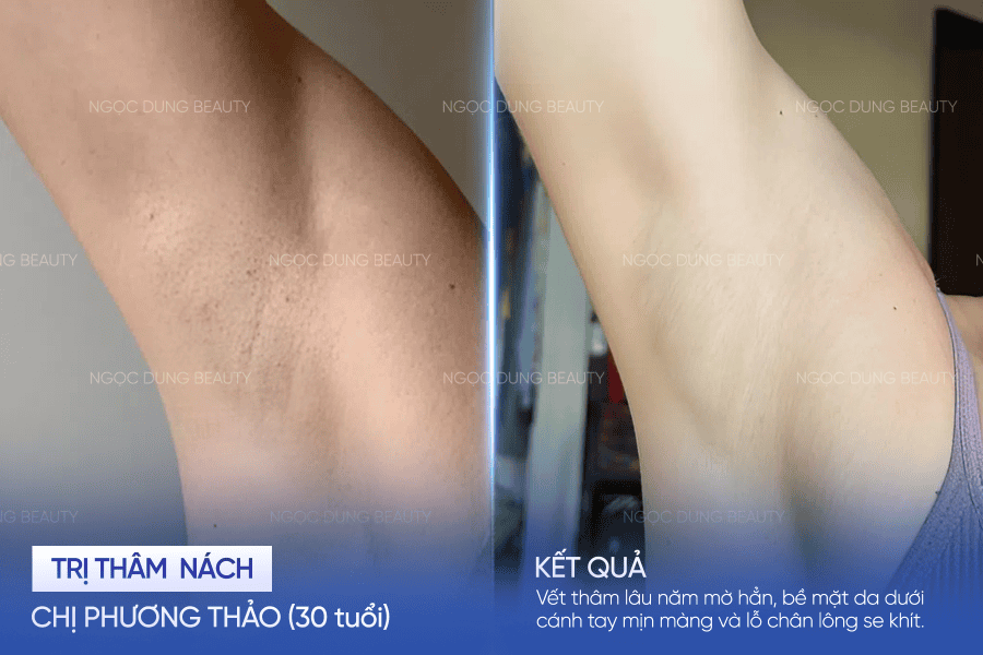 Kết quả thực tế của khách hàng sau khi điều trị thâm nách tại Ngọc Dung