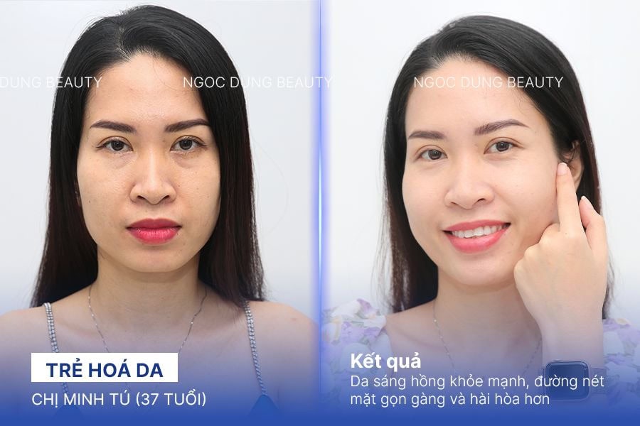 Khách hàng sở hữu vẻ đẹp tươi tắn rạng ngời sau liệu trình trẻ hóa