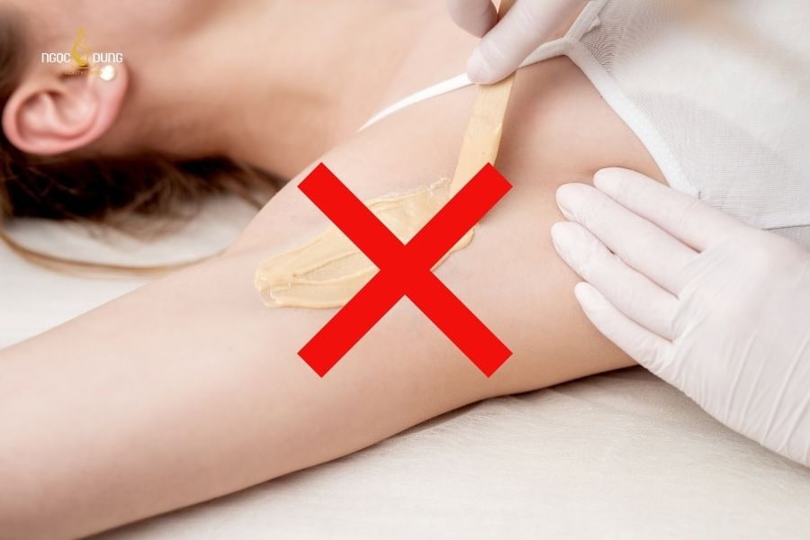 Tránh cạo hoặc wax lông trước liệu trình triệt lông