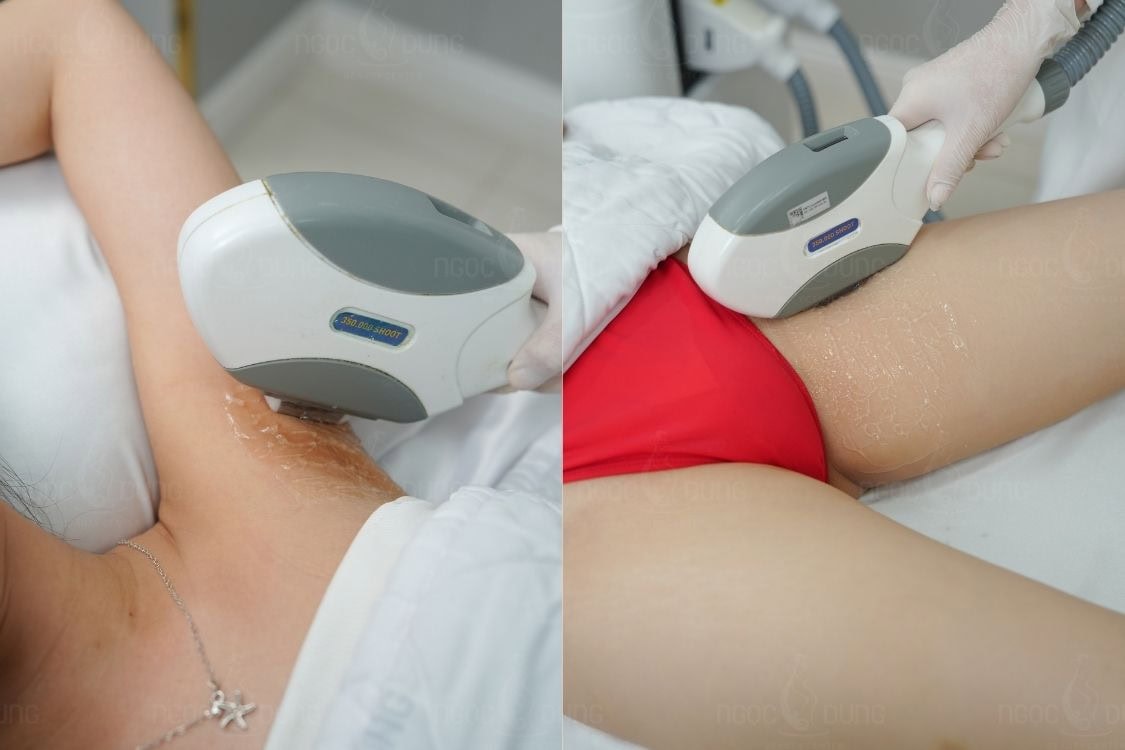 Khu vực cơ thể quyết định tần suất bạn cần quay lại thực hiện các buổi triệt tiếp theo