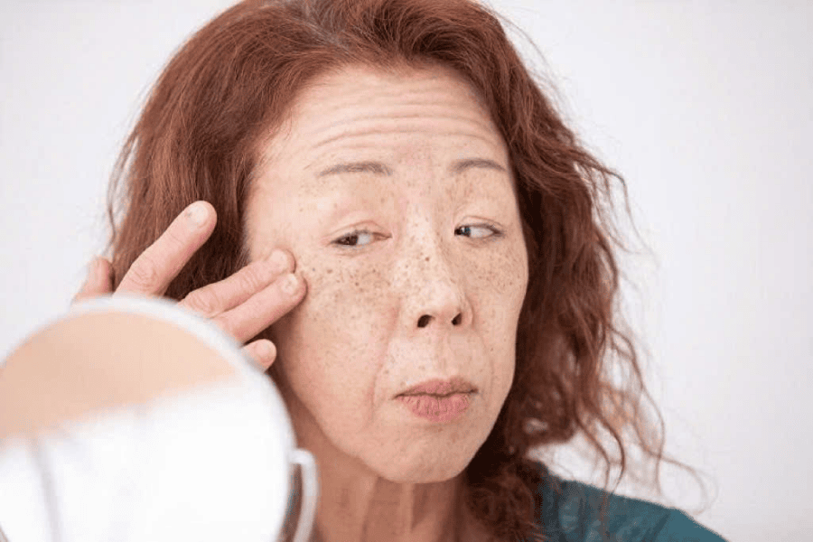 Cách ngăn ngừa nám da hiệu quả giúp duy trì làn da sáng khỏe 3 Phụ nữ tuổi trung niên dễ gặp tình trạng sạm nám do quá trình lão hóa và suy giảm nội tiết