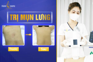nguyên nhân và 13 cách trị mụn lưng và vai cho nam và nữ