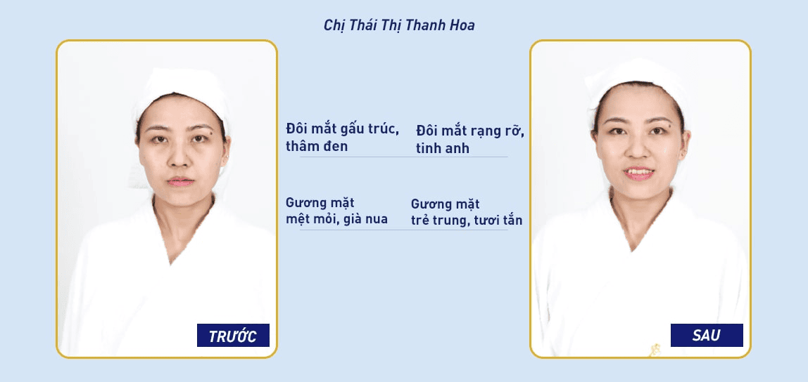 Nhiều khách hàng lấy lại đôi mắt tươi tắn tại Ngọc Dung 