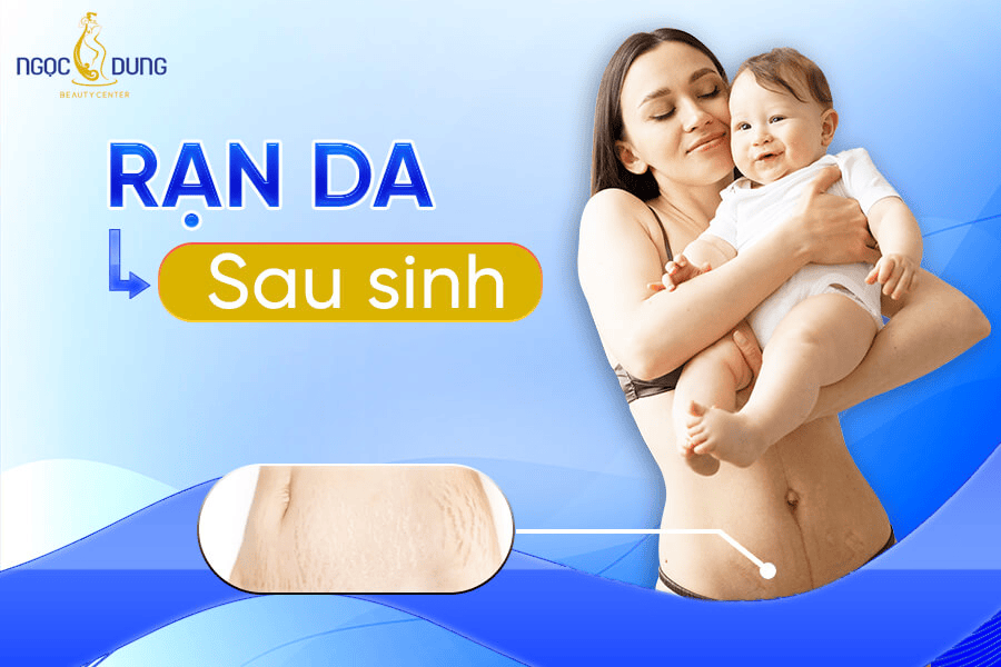 Những cách trị rạn da sau sinh an toàn và hiệu quả nhất 2026 