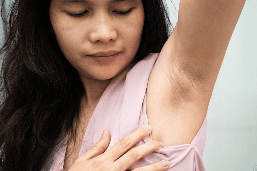 Những đối tượng nên điều trị thâm nách bằng laser