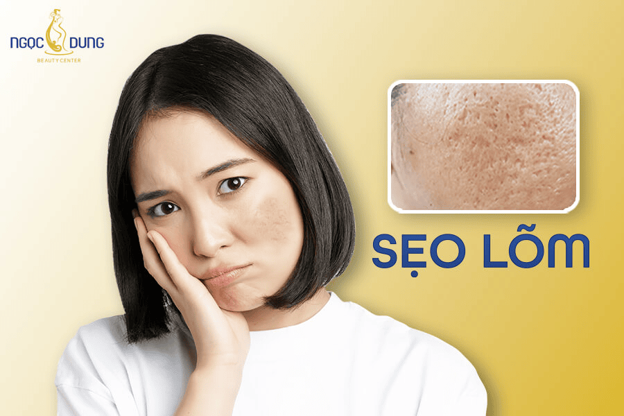 Những phương pháp lấp đầy sẹo rỗ hiệu quả