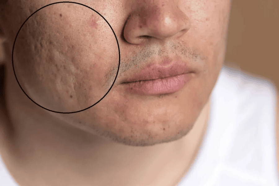 Sẹo lõm là hệ quả của sự đứt gãy các sợi collagen và elastin trong quá trình tự làm lành vết thương, khiến mô da không thể lấp đầy khoảng trống