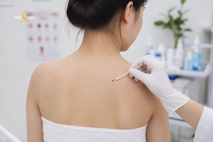 Người dùng không nên tự mua hóa chất để chấm nốt ruồi tại nhà
