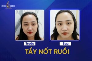 tẩy nốt ruồi ở đâu an toàn cách tẩy nốt ruồi nhanh, không đau, không để lại sẹo