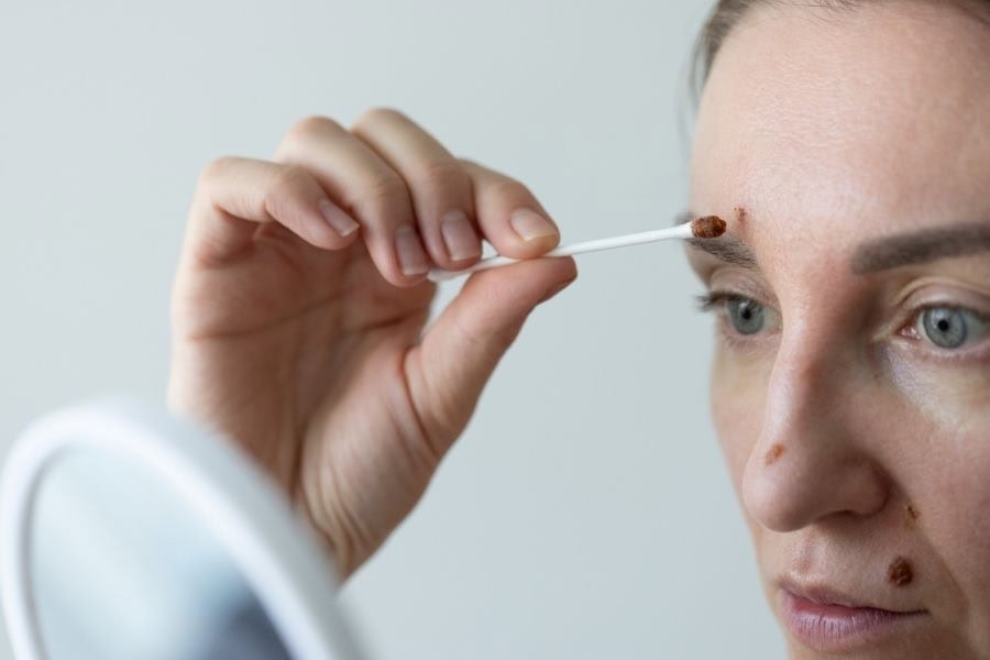 Dùng thuốc tẩy nốt ruồi tại nhà cần lưu ý về nồng độ để tránh kích ứng da