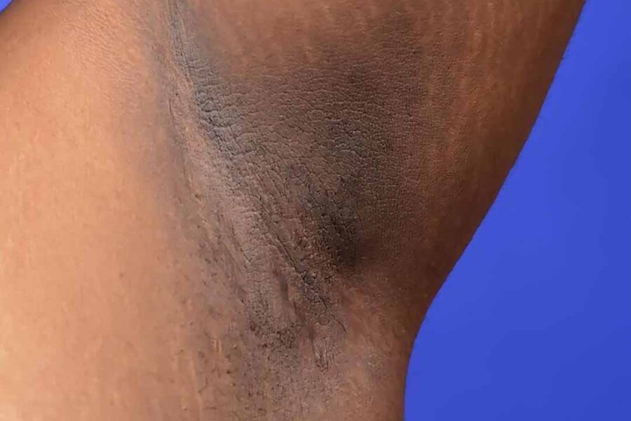 Nách bị thâm do bệnh Acanthosis nigricans