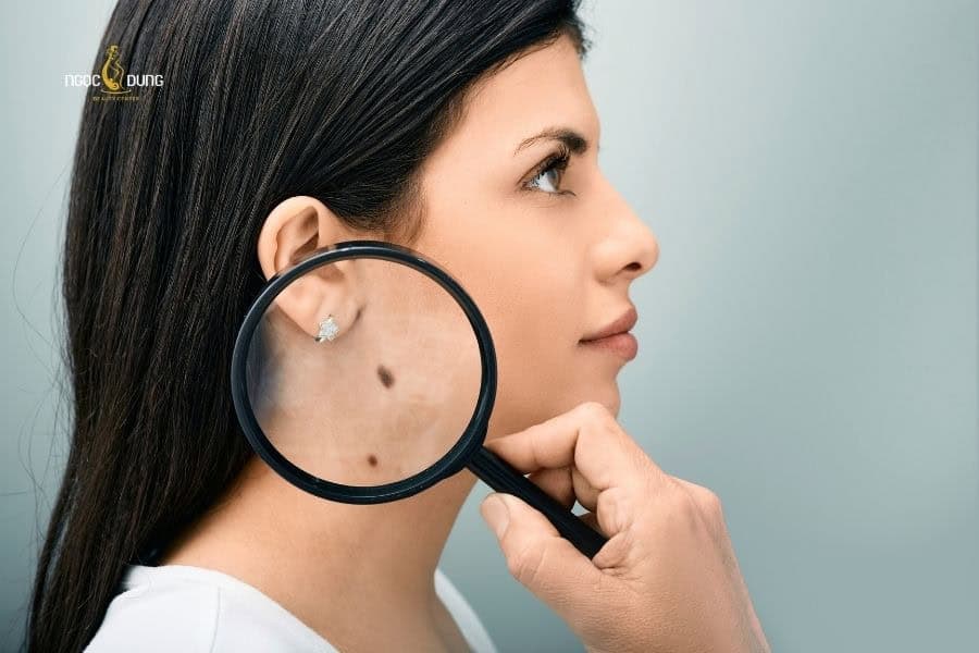 Cần theo dõi tình trạng nốt ruồi định kỳ để kịp thời xử lý các biến chứng nguy hiểm cho da