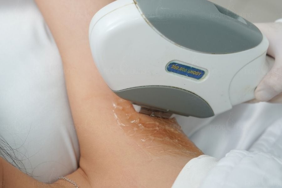  Thời gian giữa các lần triệt lông thường 2–4 tuần/lần ở giai đoạn đầu và 4-8 tuần/lần ở giai đoạn duy trì