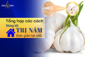 Tỏi trị nám được không? Tổng hợp các cách dùng tỏi trị nám siêu đơn giản và tiện lợi cho chị em