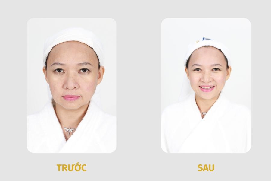 Trẻ hóa da mặt có thể duy trì 1-3 năm