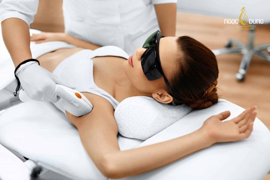 Trị thâm nách bằng laser