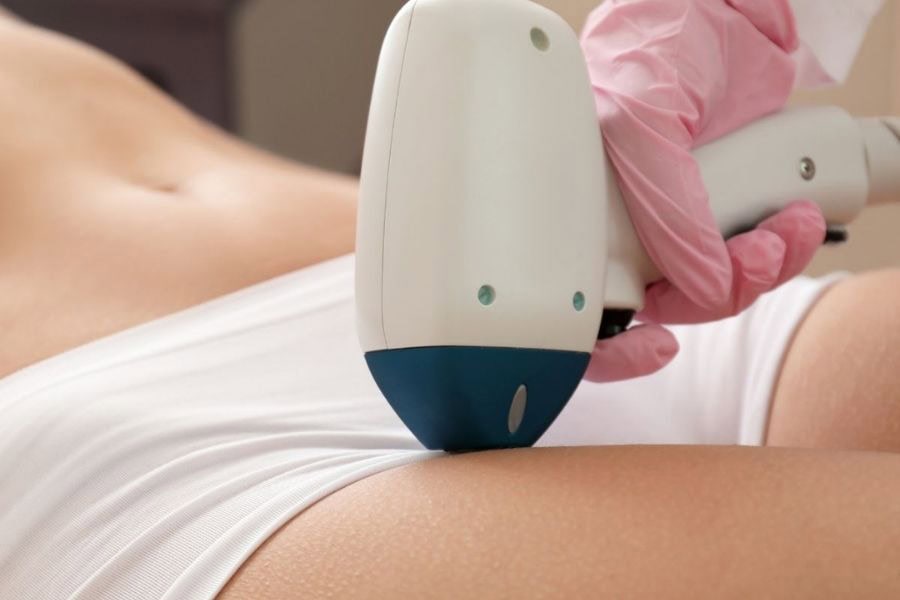 Triệt bikini tạo hình là gì? Các kiểu tạo hình vùng bikini phổ biến 13 Triệt lông bikini không còn xa lạ với phụ nữ hiện đại