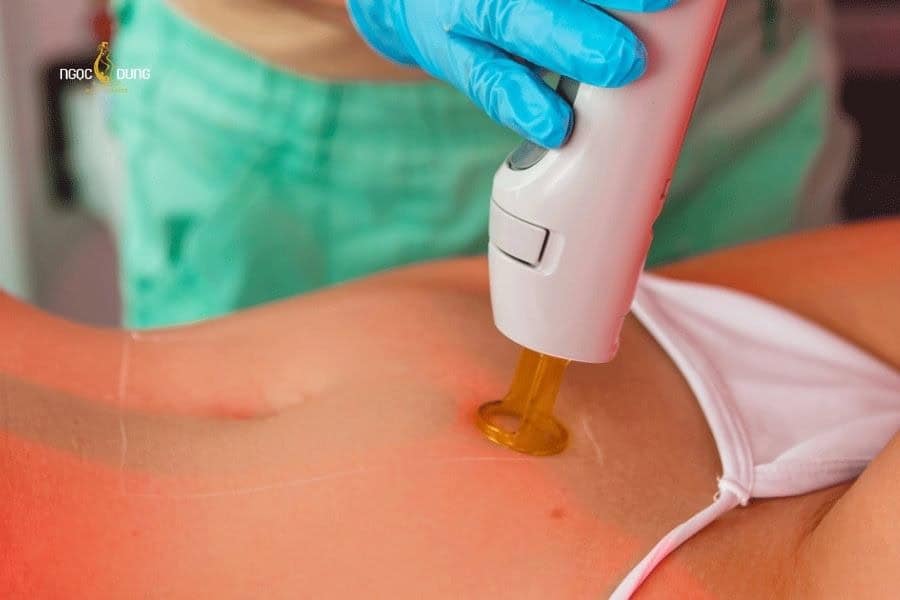 Laser có thể áp dụng cho cả triệt lông bụng nam và nữ