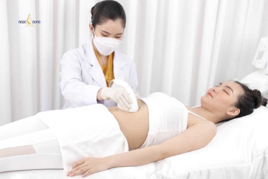 Ngọc Dung mang đến dịch vụ triệt lông bụng êm ái và an toàn cho da