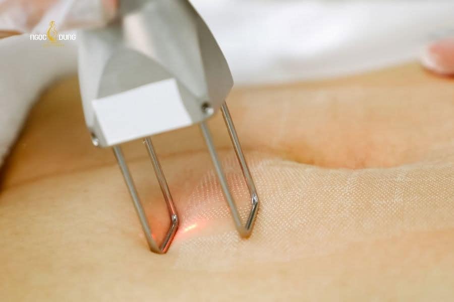 Triệt lông vùng bụng có giá khác nhau ở từng cơ sở