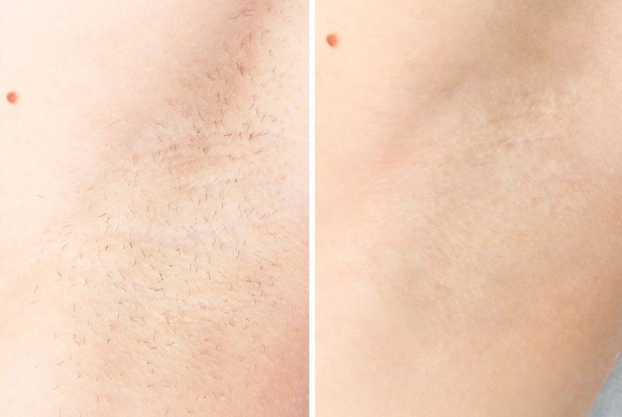 Cần đi triệt lông ít nhất 6 buổi để đạt hiệu quả như mong muốn