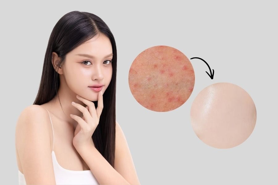 Cách tẩy lông mặt tại nhà cực an toàn, không lo kích ứng 4 Cách triệt lông mặt vĩnh viễn có thể hỗ trợ giảm viêm nang lông