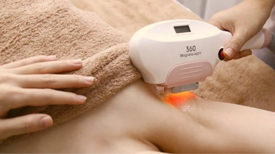 Triệt lông nách bằng IPL