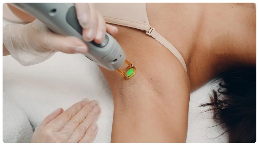 Triệt lông nách bằng tia laser là gì? Có hiệu quả không? 10 Kiểm soát năng lượng Laser – yếu tố quan trọng để bảo vệ làn da