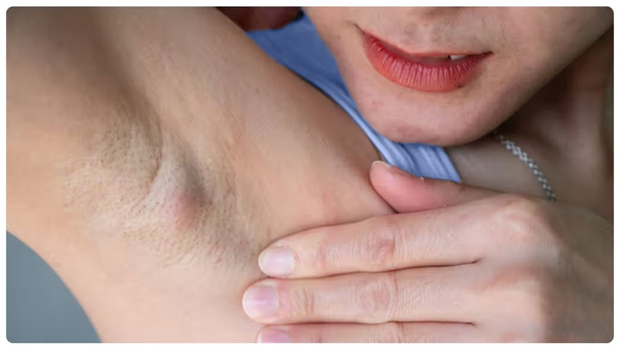 Triệt lông nách bằng tia laser là gì? Có hiệu quả không? 2 Hiệu quả triệt lông nách duy trì lâu dài khi thực hiện đúng cách