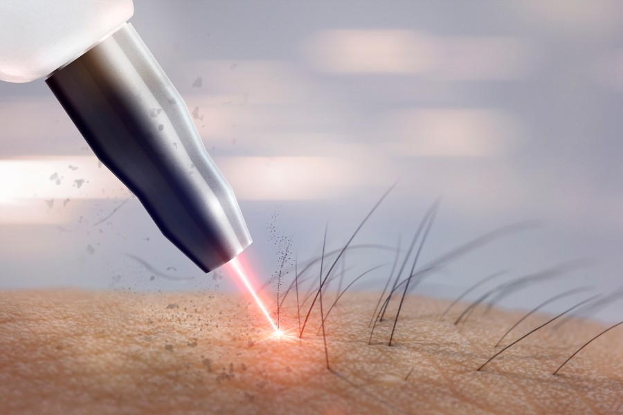 Sau khi kết thúc liệu trình triệt lông nách bằng laser làn da có thể hơi đỏ hoặc bị kích ứng Sau khi kết thúc liệu trình triệt lông nách bằng laser làn da có thể hơi đỏ hoặc bị kích ứng