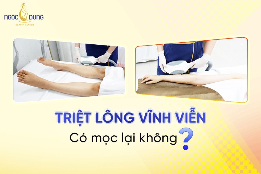 triệt lông vĩnh viễn có mọc lại không