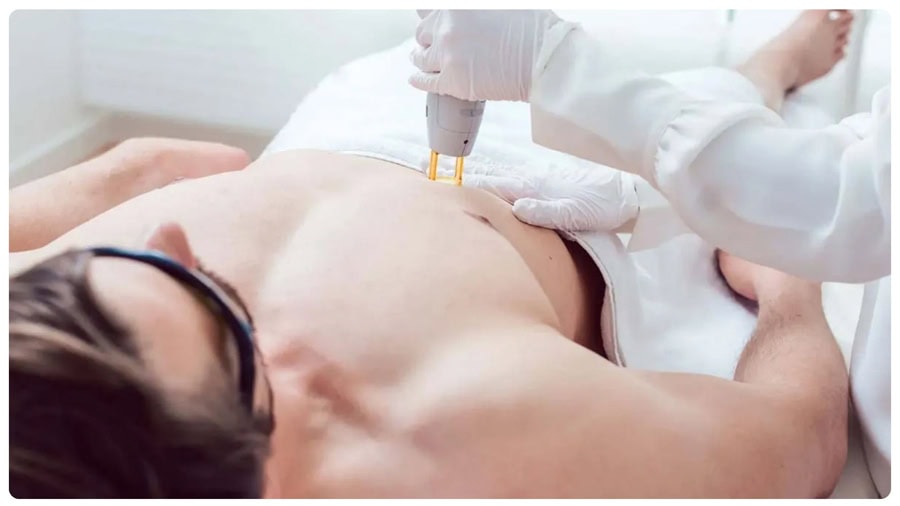 Sử dụng Laser công nghệ cao để triệt lông vùng kín nam