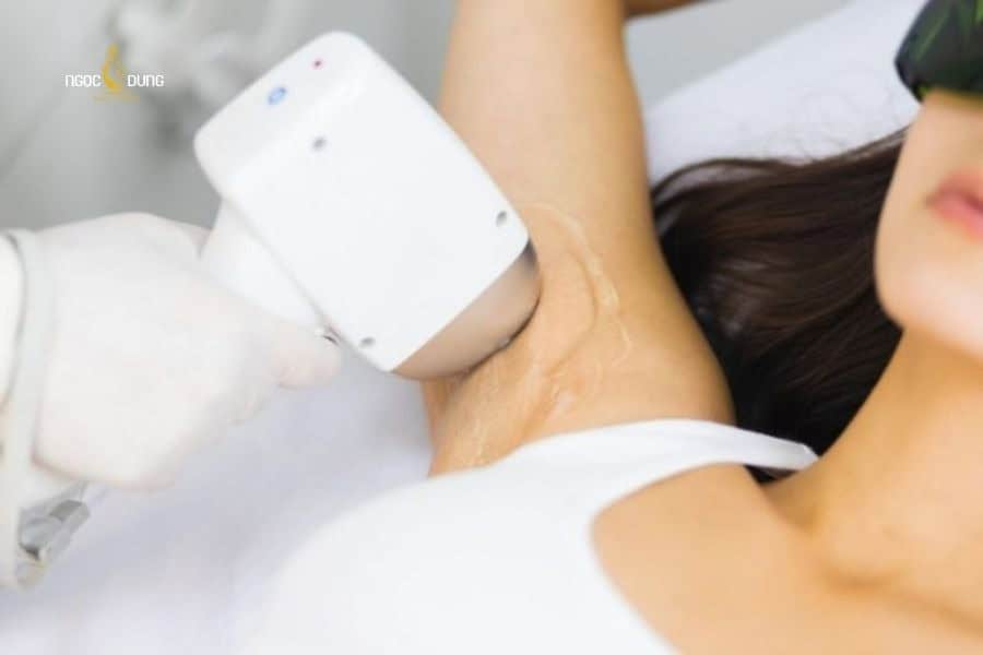 Triệt lông nách bằng công nghệ laser được đánh giá là giải pháp hiệu quả nhất hiện nay