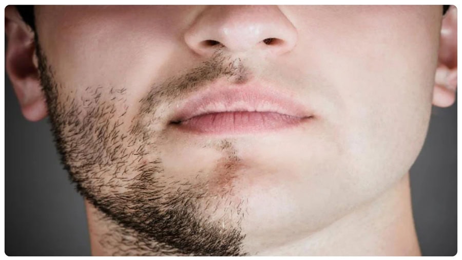 Râu mọc nhanh không còn là nỗi bận tâm khi chọn đúng cách triệt râu