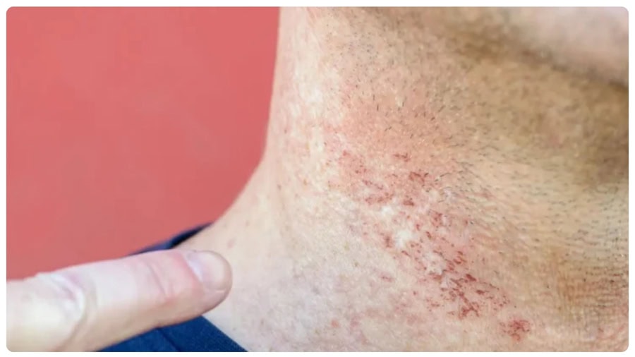 Không nên triệt râu khi da bị viêm, trầy xước